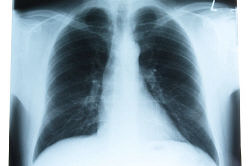 X ray photograph of person ribcage an 4.jpg