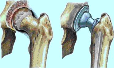 olikiarthroplastiki1