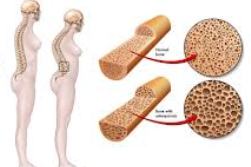 new35_osteoporosis.jpg