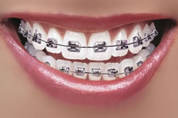 new42_toothbrace.jpg