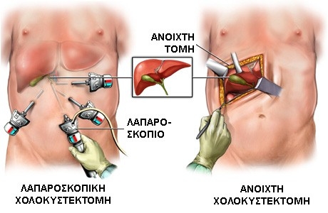 images_30_143163-laparoskopisi.jpg