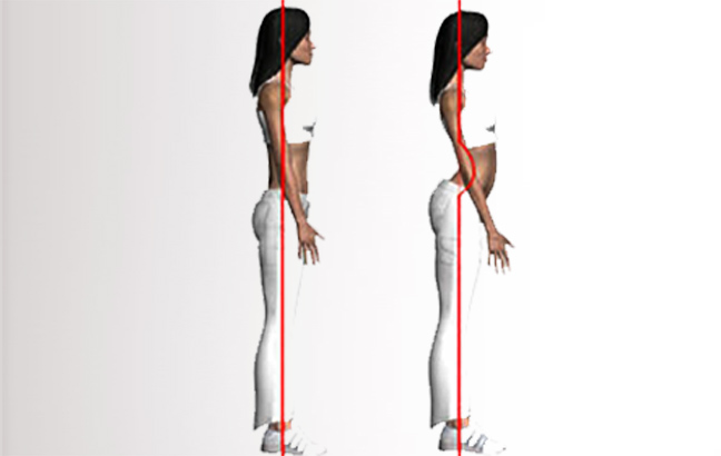 images_30_lordosis03.jpg