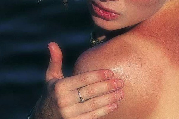 images_2512017_sunburn.jpg