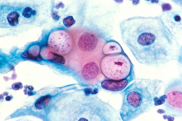 images_1882017_2_600px-Pap_smear_showing_clamydia_in_the_vacuoles_500x_HE.jpg
